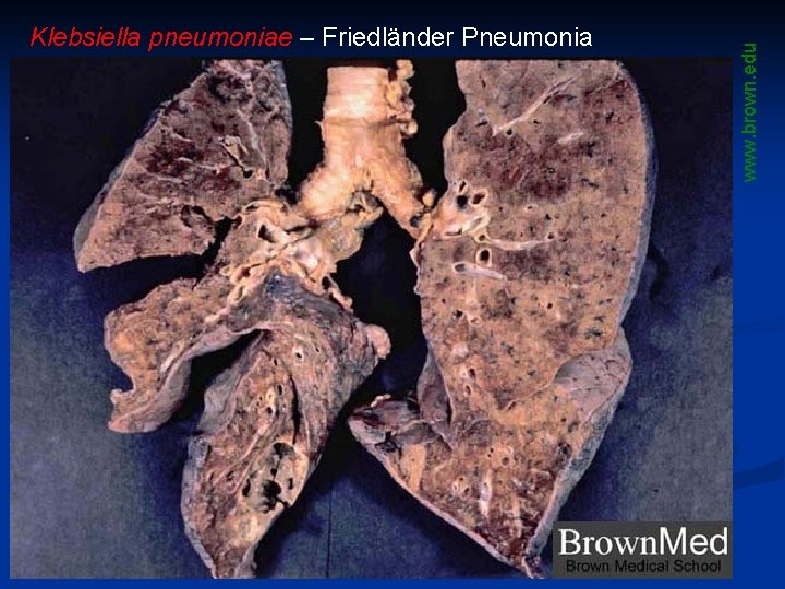 www. brown. edu Klebsiella pneumoniae – Friedländer Pneumonia 