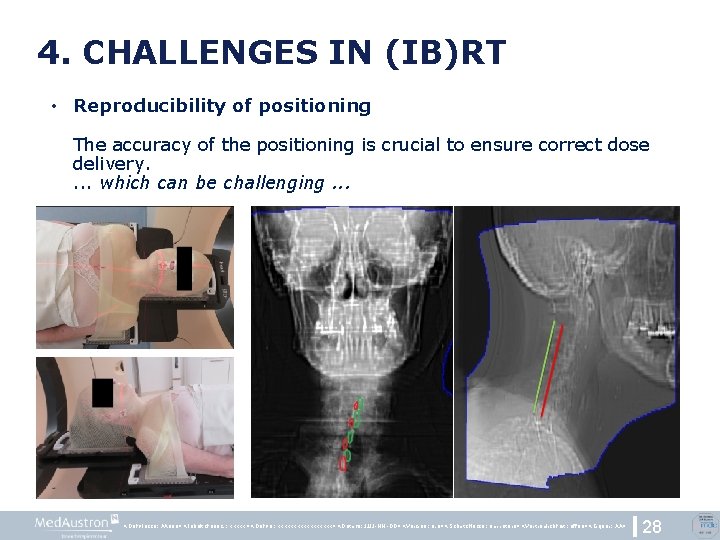 4. CHALLENGES IN (IB)RT • Reproducibility of positioning The accuracy of the positioning is