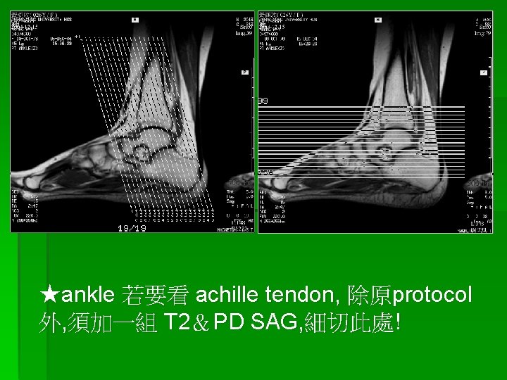 ★ankle 若要看 achille tendon, 除原protocol 外, 須加一組 T 2＆PD SAG, 細切此處! 