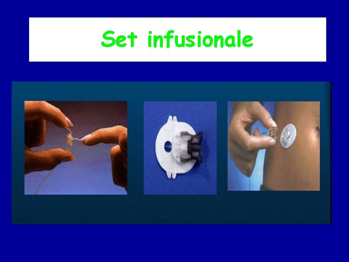 Set infusionale 