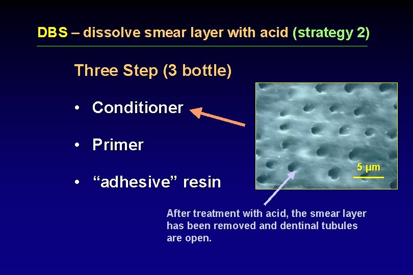 DBS – dissolve smear layer with acid (strategy 2) Three Step (3 bottle) •