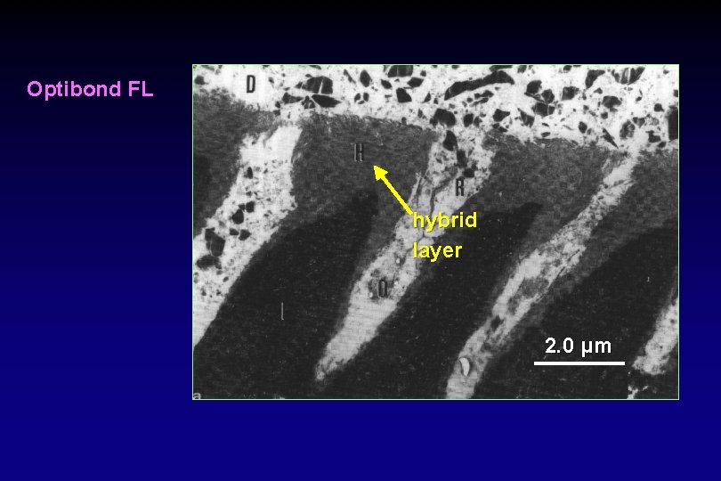 Optibond FL hybrid layer 2. 0 μm 