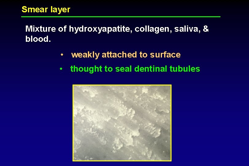 Smear layer Mixture of hydroxyapatite, collagen, saliva, & blood. • weakly attached to surface