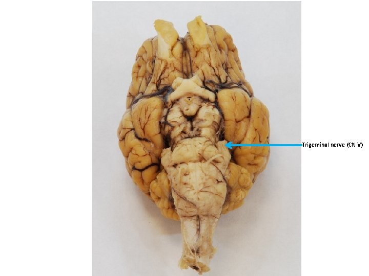 Trigeminal nerve (CN V) 