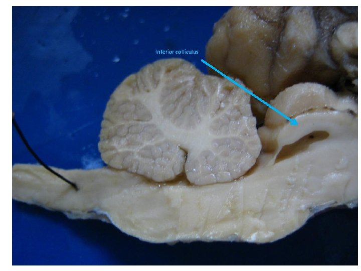 Inferior colliculus 