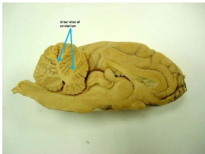 Arbor vitae of cerebellum 