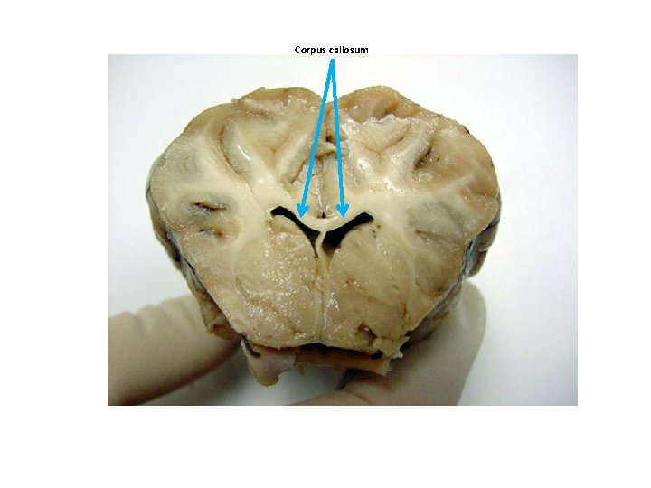 Corpus callosum 