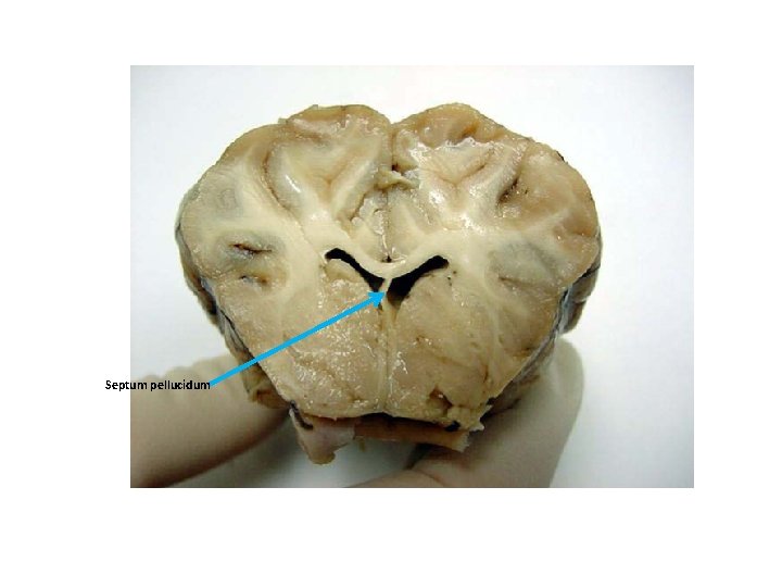 Septum pellucidum 