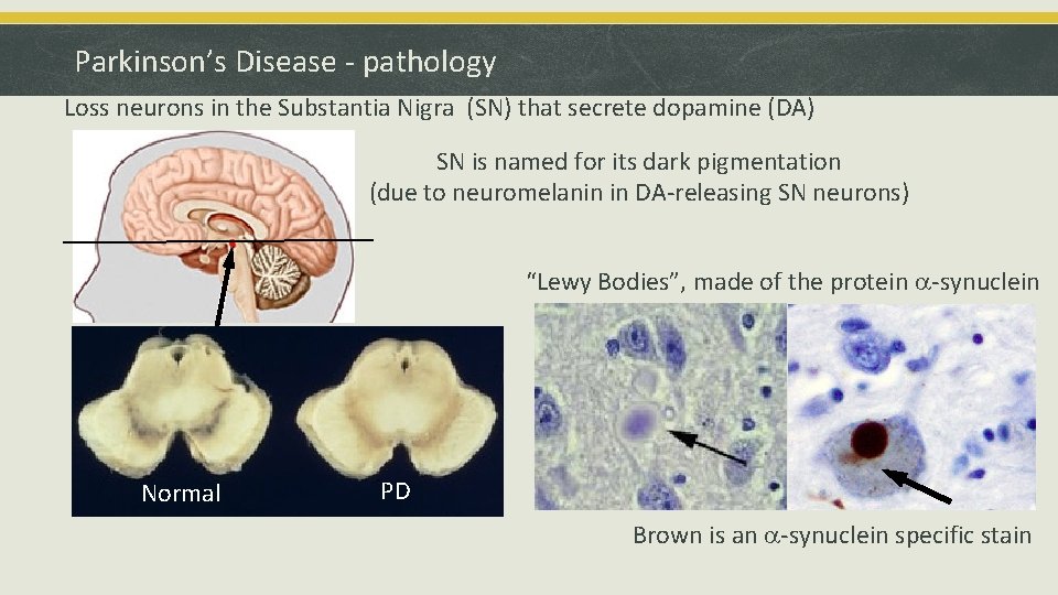 Parkinson’s Disease - pathology Loss neurons in the Substantia Nigra (SN) that secrete dopamine