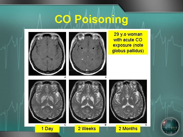 CO Poisoning 29 y. o woman with acute CO exposure (note globus pallidus) 1