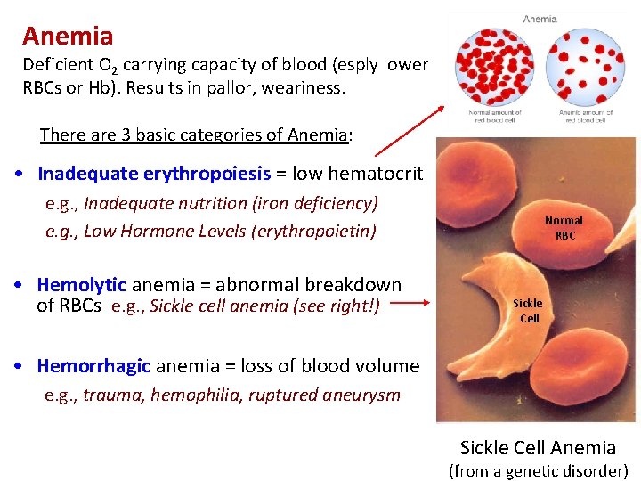 Anemia Deficient O 2 carrying capacity of blood (esply lower RBCs or Hb). Results