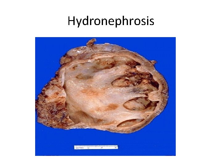 Hydronephrosis 