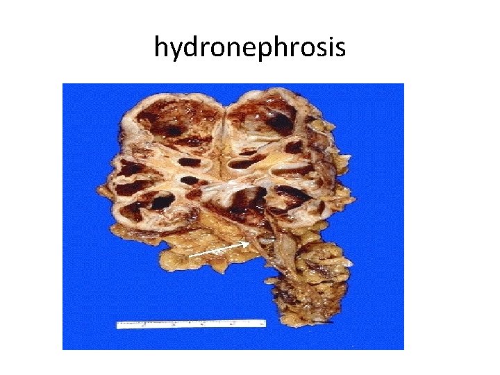 hydronephrosis 