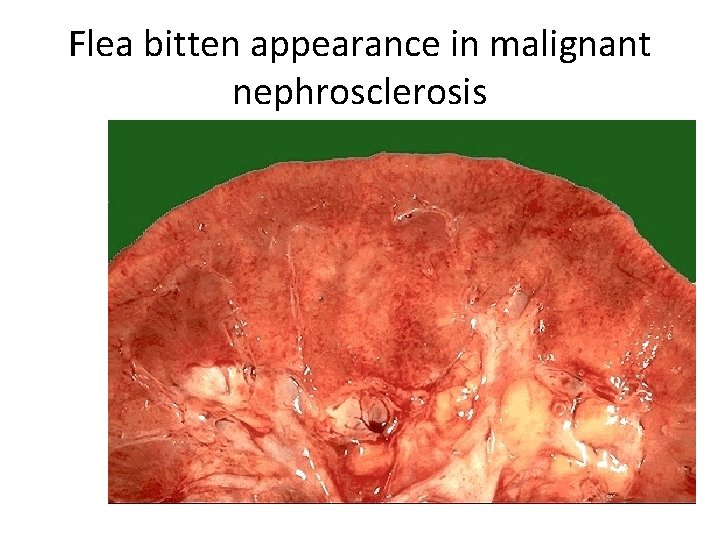 Flea bitten appearance in malignant nephrosclerosis 