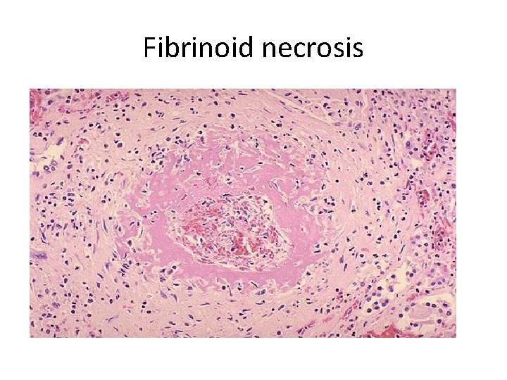 Fibrinoid necrosis 