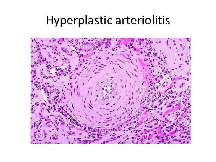 Hyperplastic arteriolitis 