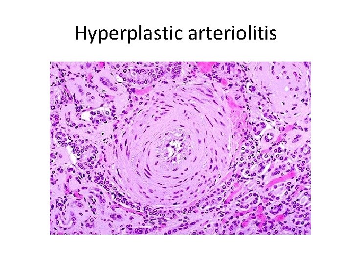 Hyperplastic arteriolitis Hyperplastic arteriolitis