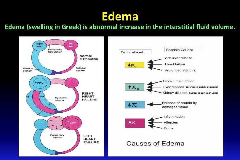 Edema (swelling in Greek) is abnormal increase in the interstitial fluid volume. Edema (swelling in Greek) is abnormal increase in the interstitial fluid volume.