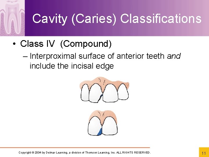 Cavity (Caries) Classifications • Class IV (Compound) – Interproximal surface of anterior teeth and