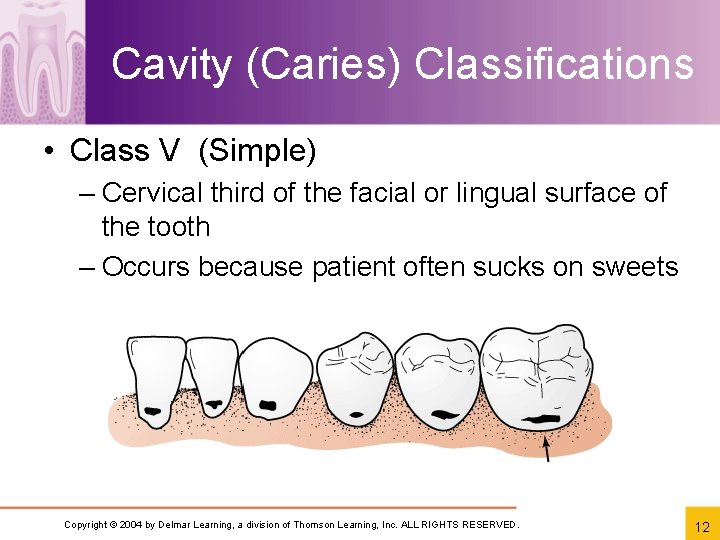 Cavity (Caries) Classifications • Class V (Simple) – Cervical third of the facial or