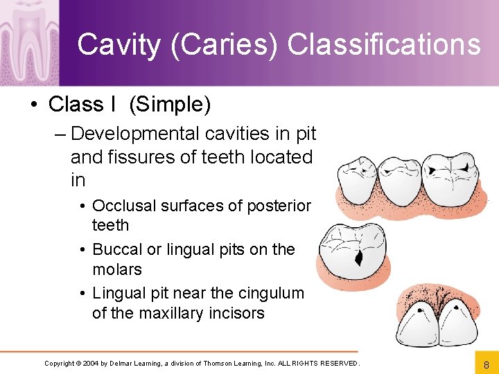 Cavity (Caries) Classifications • Class I (Simple) – Developmental cavities in pit and fissures