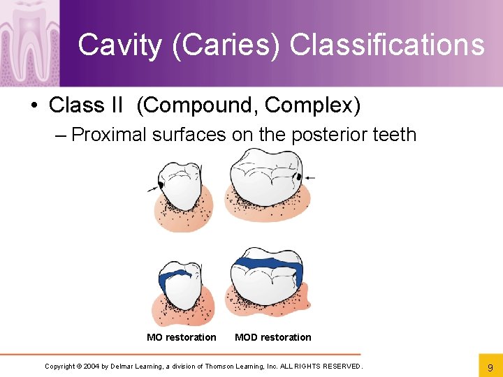 Cavity (Caries) Classifications • Class II (Compound, Complex) – Proximal surfaces on the posterior