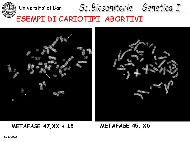 Universita’ di Bari ESEMPI DI CARIOTIPI ABORTIVI METAFASE 47, XX + 15 by GP&NA