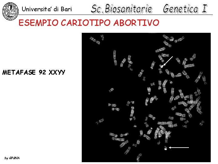 Universita’ di Bari ESEMPIO CARIOTIPO ABORTIVO METAFASE 92 XXYY by GP&NA 