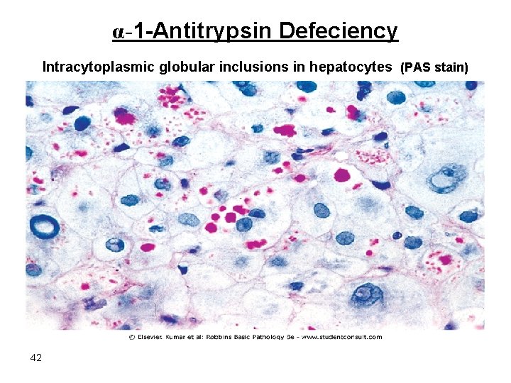 α-1 -Antitrypsin Defeciency Intracytoplasmic globular inclusions in hepatocytes (PAS stain) 42 
