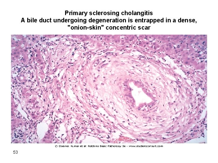 Primary sclerosing cholangitis A bile duct undergoing degeneration is entrapped in a dense, "onion-skin"