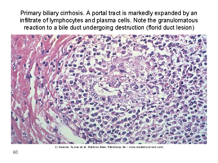 Primary biliary cirrhosis. A portal tract is markedly expanded by an infiltrate of lymphocytes