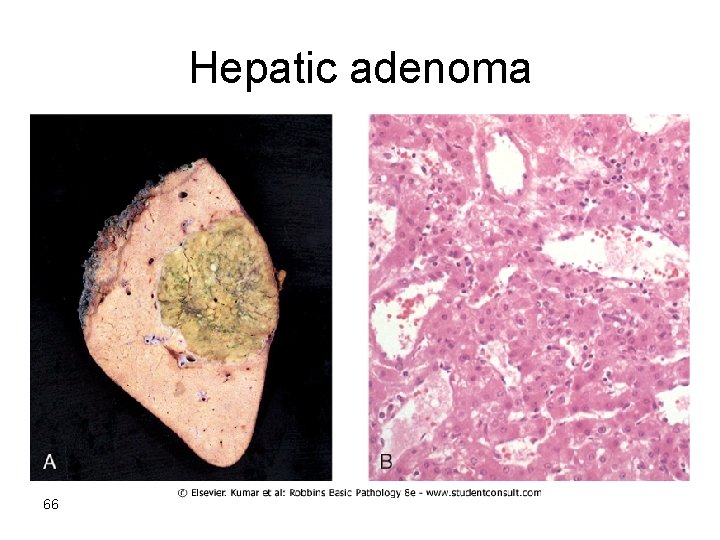 Hepatic adenoma 66 