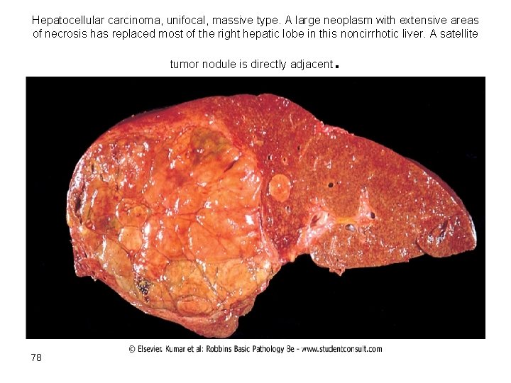 Hepatocellular carcinoma, unifocal, massive type. A large neoplasm with extensive areas of necrosis has