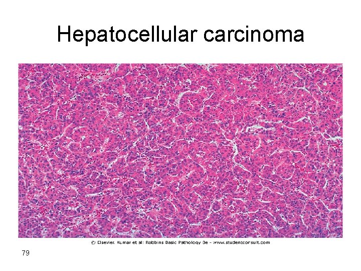 Hepatocellular carcinoma 79 