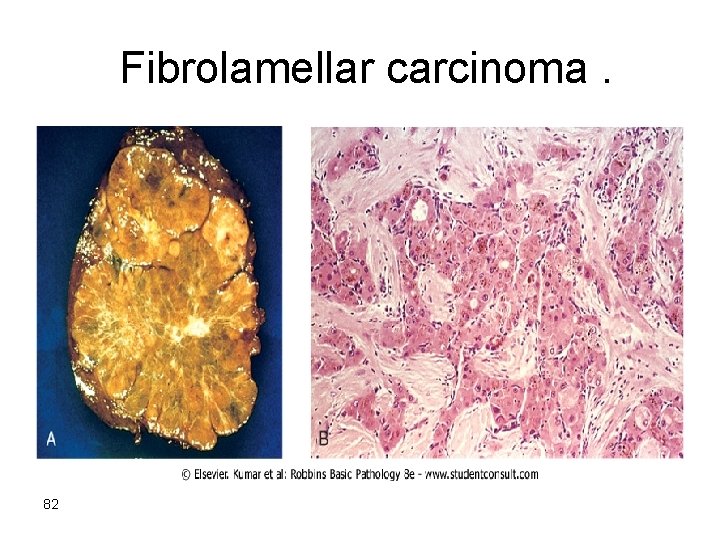 Fibrolamellar carcinoma. 82 