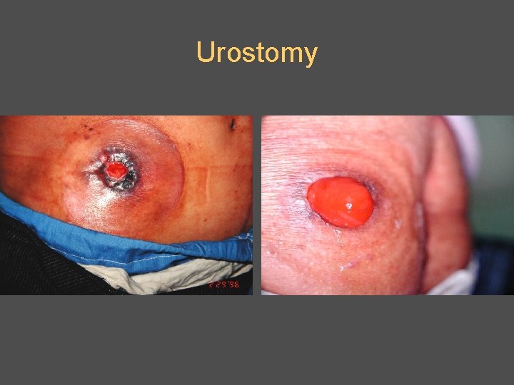 Urostomy 