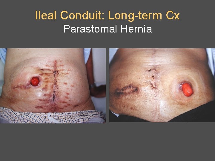 Ileal Conduit: Long-term Cx Parastomal Hernia 