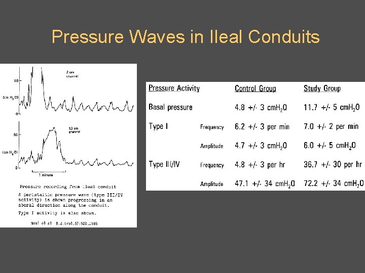 Pressure Waves in Ileal Conduits 
