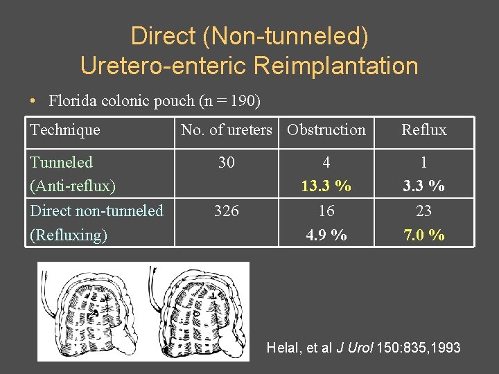 Direct (Non-tunneled) Uretero-enteric Reimplantation • Florida colonic pouch (n = 190) Technique Tunneled (Anti-reflux)