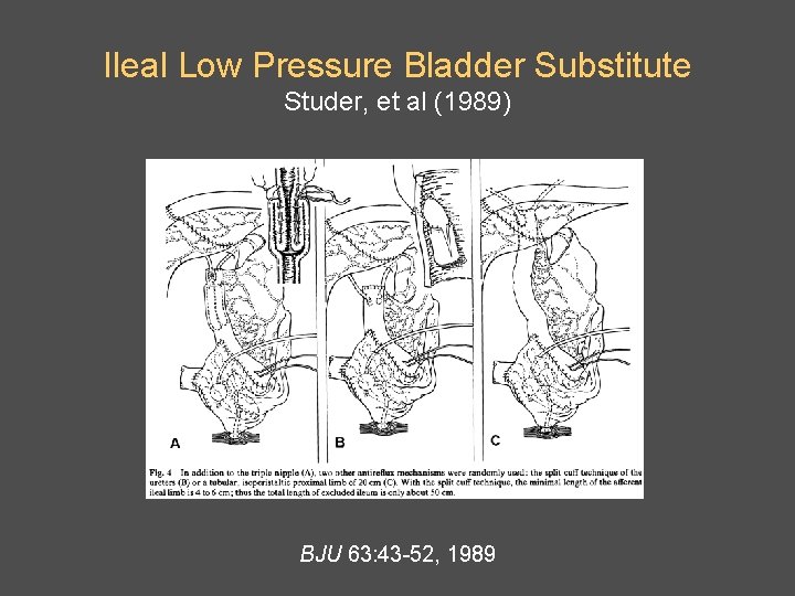 Ileal Low Pressure Bladder Substitute Studer, et al (1989) BJU 63: 43 -52, 1989