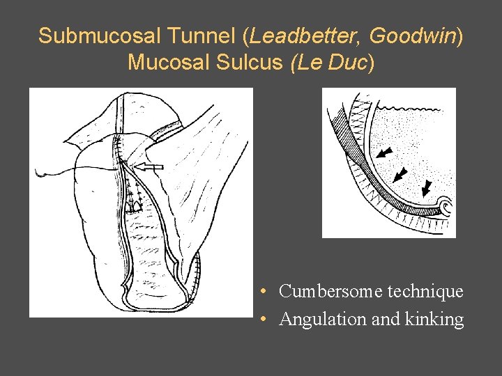 Submucosal Tunnel (Leadbetter, Goodwin) Mucosal Sulcus (Le Duc) • Cumbersome technique • Angulation and