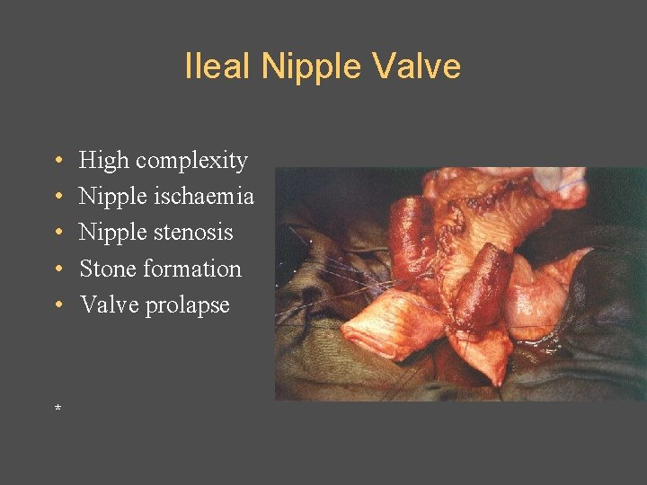 Ileal Nipple Valve • • • * High complexity Nipple ischaemia Nipple stenosis Stone