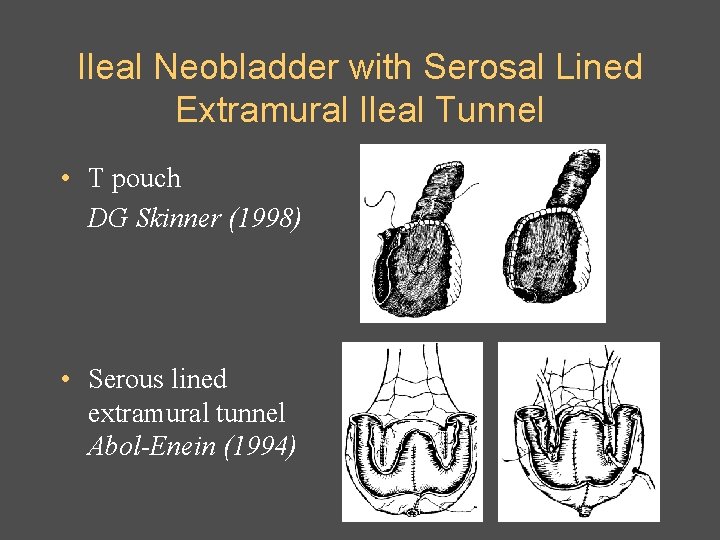 Ileal Neobladder with Serosal Lined Extramural Ileal Tunnel • T pouch DG Skinner (1998)