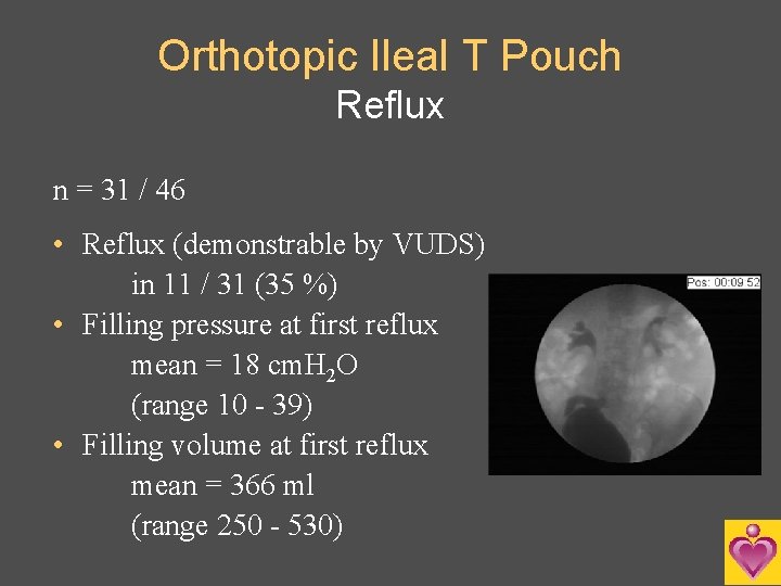 Orthotopic Ileal T Pouch Reflux n = 31 / 46 • Reflux (demonstrable by