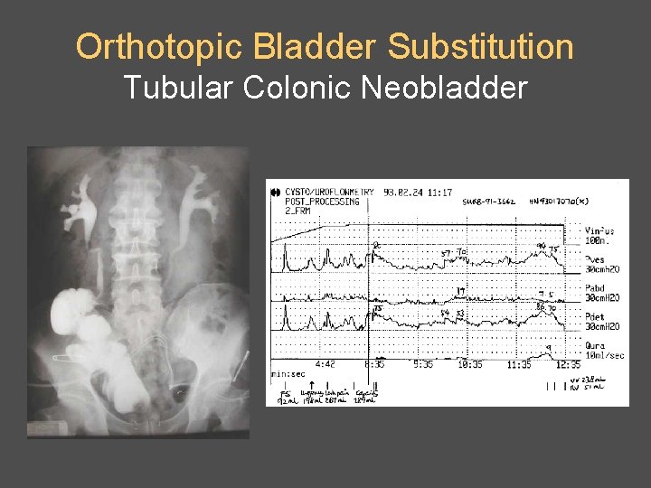 Orthotopic Bladder Substitution Tubular Colonic Neobladder 