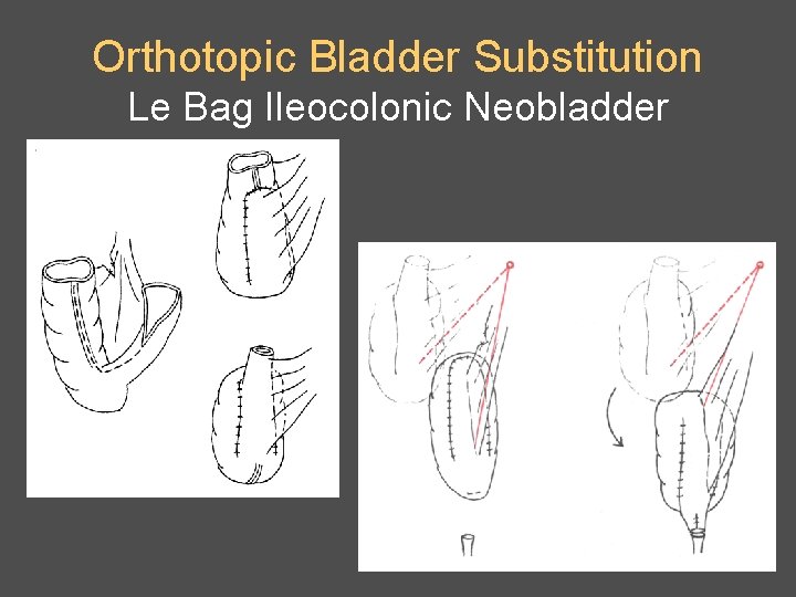 Orthotopic Bladder Substitution Le Bag Ileocolonic Neobladder 