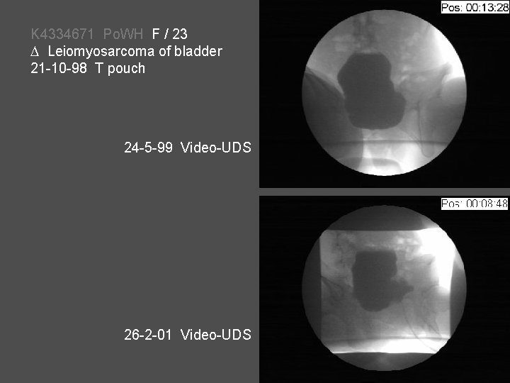 K 4334671 Po. WH F / 23 Leiomyosarcoma of bladder 21 -10 -98 T