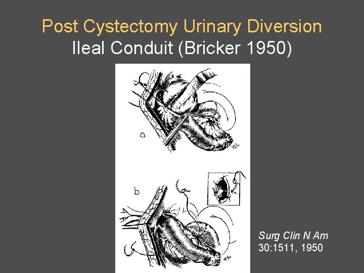 Post Cystectomy Urinary Diversion Ileal Conduit (Bricker 1950) Surg Clin N Am 30: 1511,