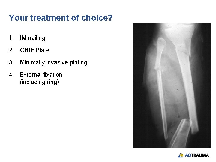 Your treatment of choice? 1. IM nailing 2. ORIF Plate 3. Minimally invasive plating