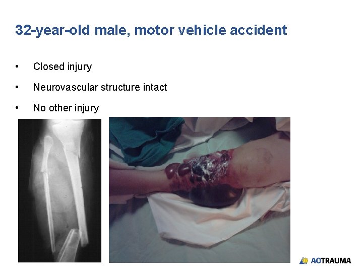 32 -year-old male, motor vehicle accident • Closed injury • Neurovascular structure intact •
